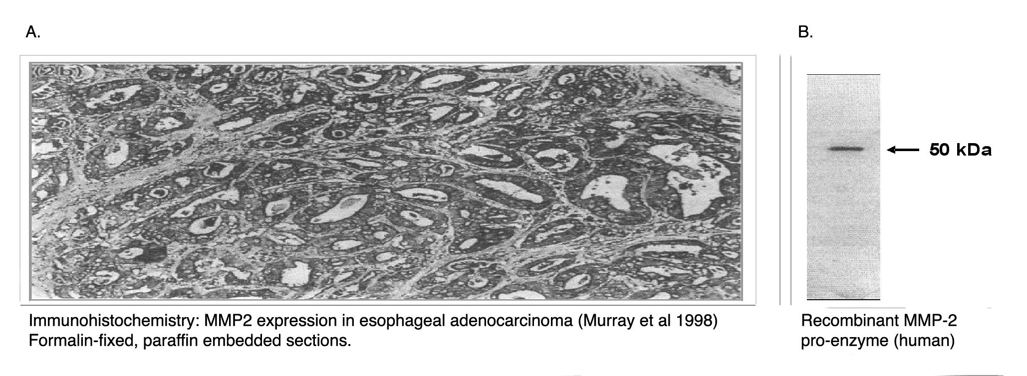 "A. Immunohistochemical staining of human oesophageal adenocarcinoma tissue using MMP-2 antibody (Cat. No. X2054M).
B.  Western blot using MMP-2 antibody on recombinant MMP-2 proenzyme (400 ng/lane). "